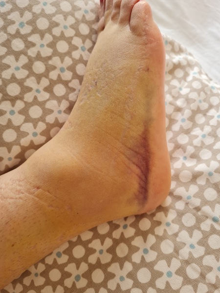 Sprained ankle - ARGHHH