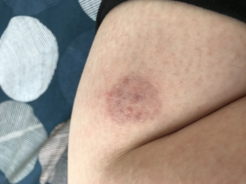Red round patch on skin so worried :( 