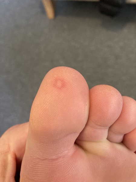 What is this on my toe?