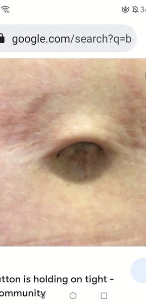 Adult Umbilical Hernia