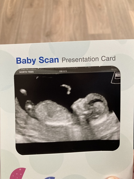 Anyone want to guess my baby’s gender from scan pic?