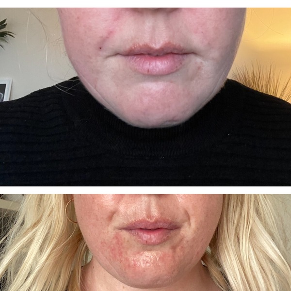 For those of you who have Botox injections…