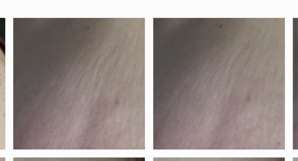 Breast changes/indent **reposting as put in wrong thread!**