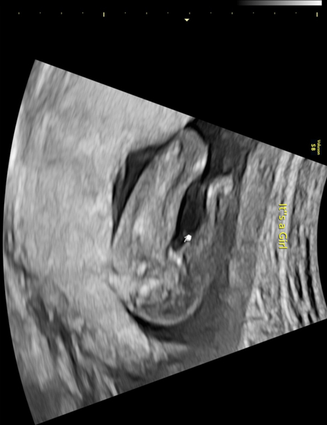 Baby scan 16 weeks