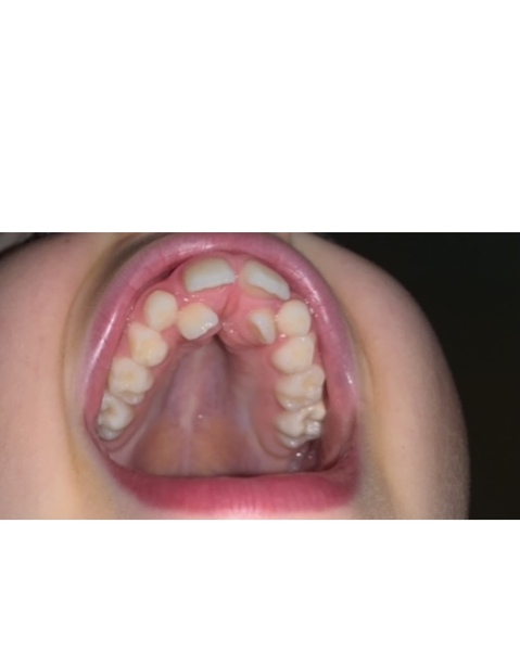 Advice on DS teeth (pic attached!)