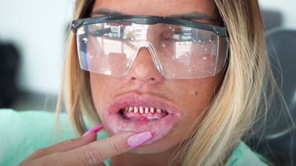 AIBU to think people are ruining their teeth with veneers
