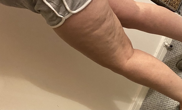 To think I might have lipedema? Anyone know anything about it?