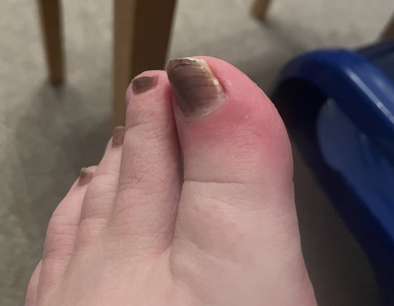 Infected In growing toenail