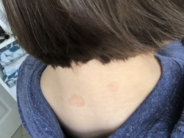 Red patches on my neck, what could these be?!