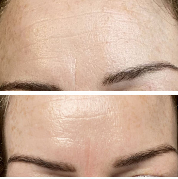 Vertical line between brows…