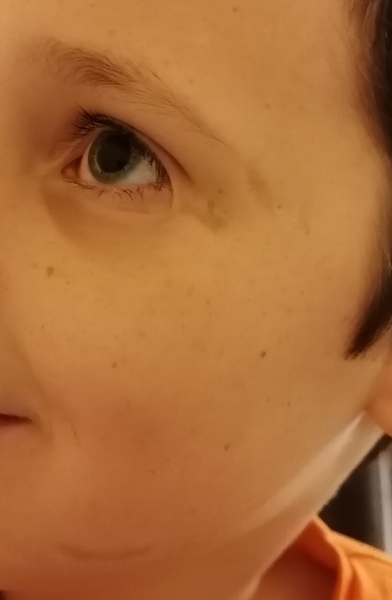 Scar on child's face - mum guilt