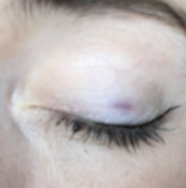 What’s this on my eyelid?