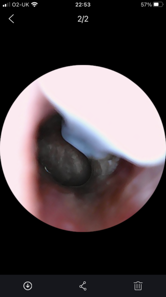Any experts on what ear drum looks like?