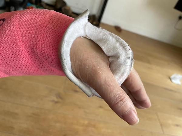 Broken wrist in bad position? **GRAPHIC PIC WARNING**