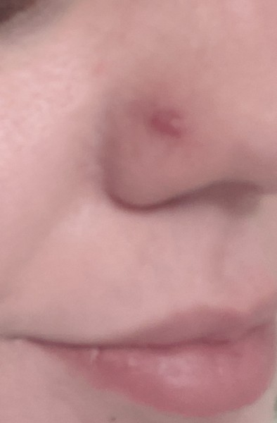 Nose piercing infected