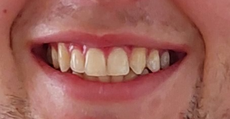 Advice on braces needed.