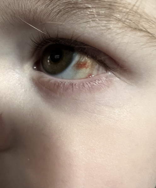 Yellow eye after conjunctivitis