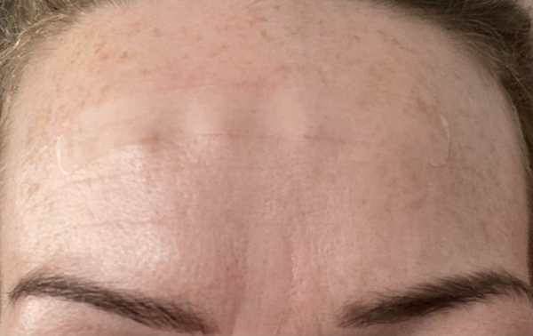 Vertical line between brows…