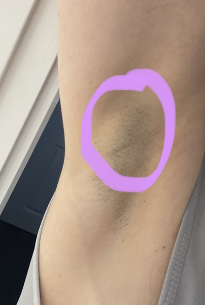 Is this a swollen lymph node in my armpit ?