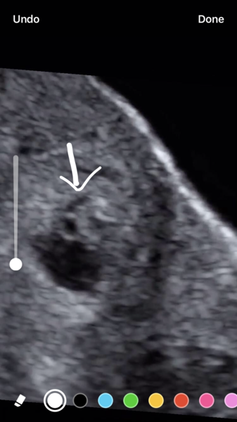 BFPs following IVF to take symptoms & scans