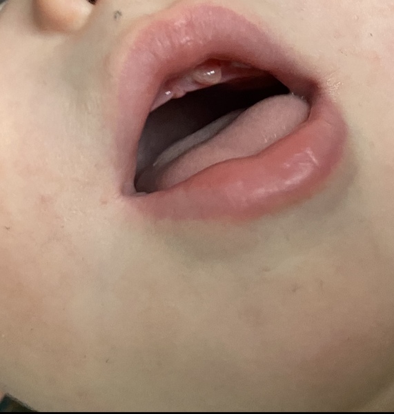 Baby teething blister