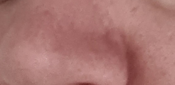 Blackhead help.please