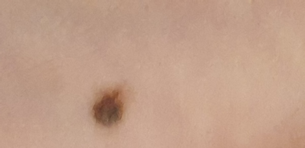 Dodgy mole on a 7 year old?