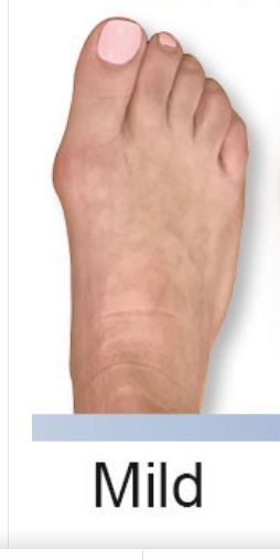 Terrified I will need bunion surgery later?