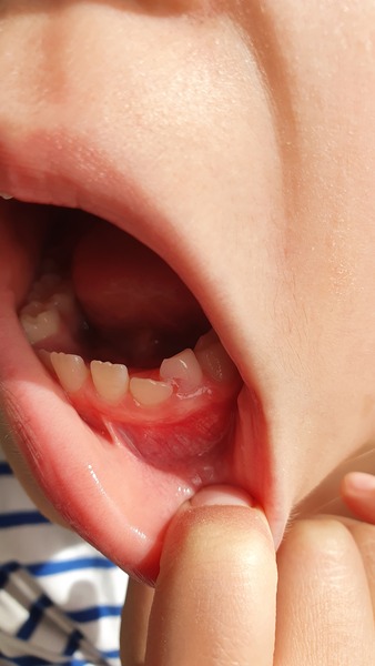 Adult tooth growing into baby tooth, 7yo