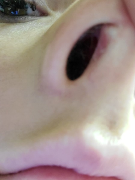 What is this lump inside my nose?