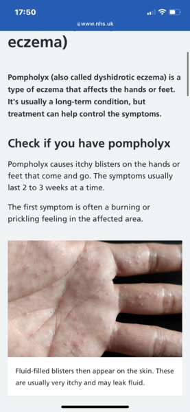 Eczema spots on baby’s feet?