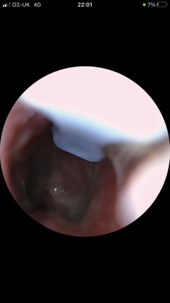 Any experts on what ear drum looks like?