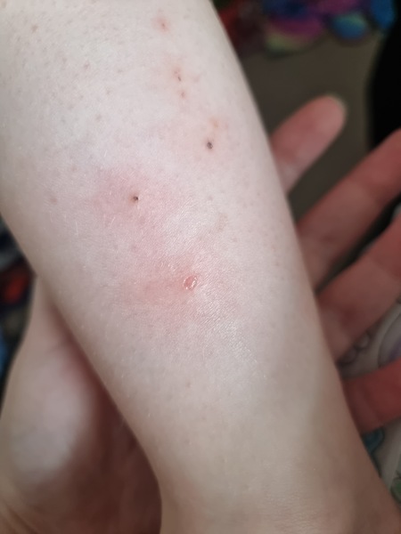 Being bit all over but have no idea by what?