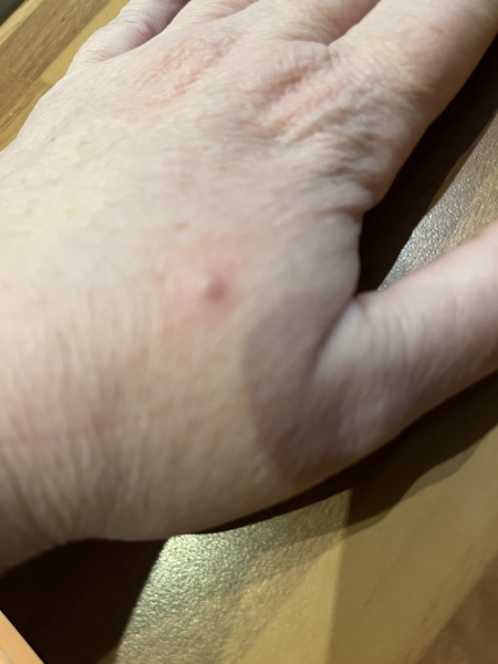 What’s this lump on my hand (pic)