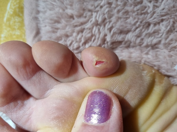 I should not have cut this blister open. Help