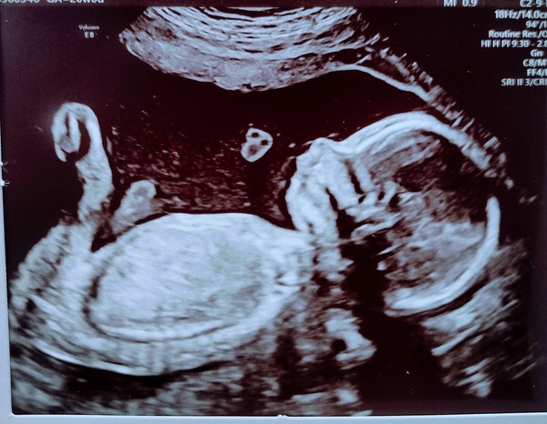 Due September 2022 (Thread 5!)