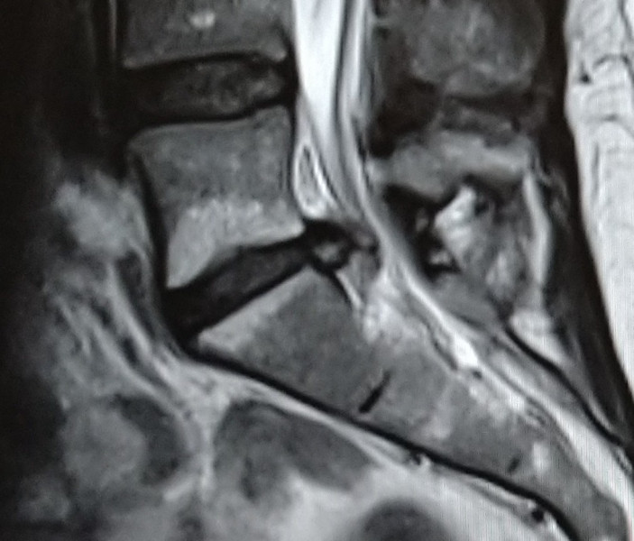 Could this be cauda equina