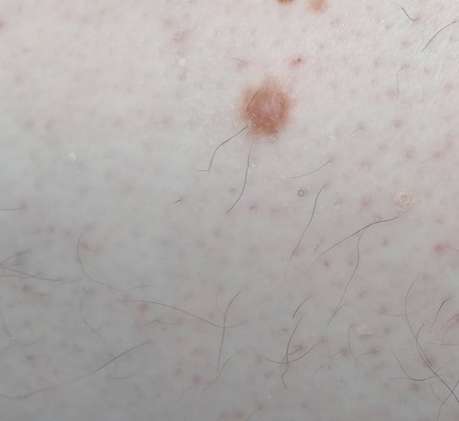 Is this mole something to worry about