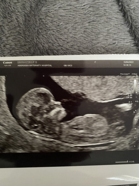 Navigating pregnancy after loss thread 2