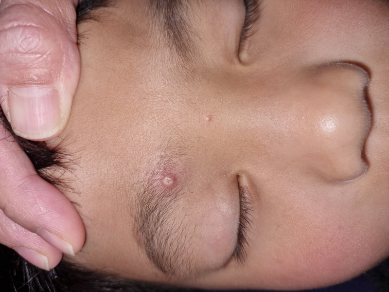 Molluscum- help!