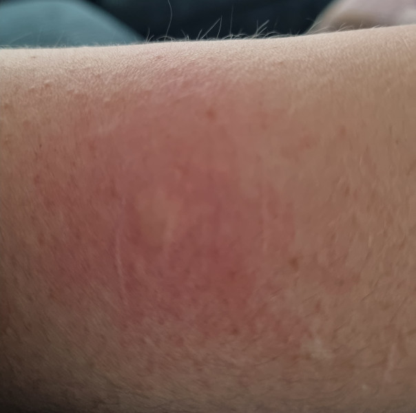 Is this hives or something else?