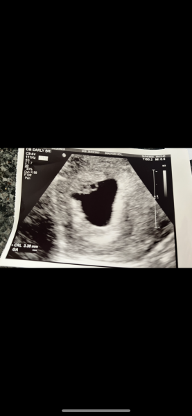 Twins developing at different rates or VT??