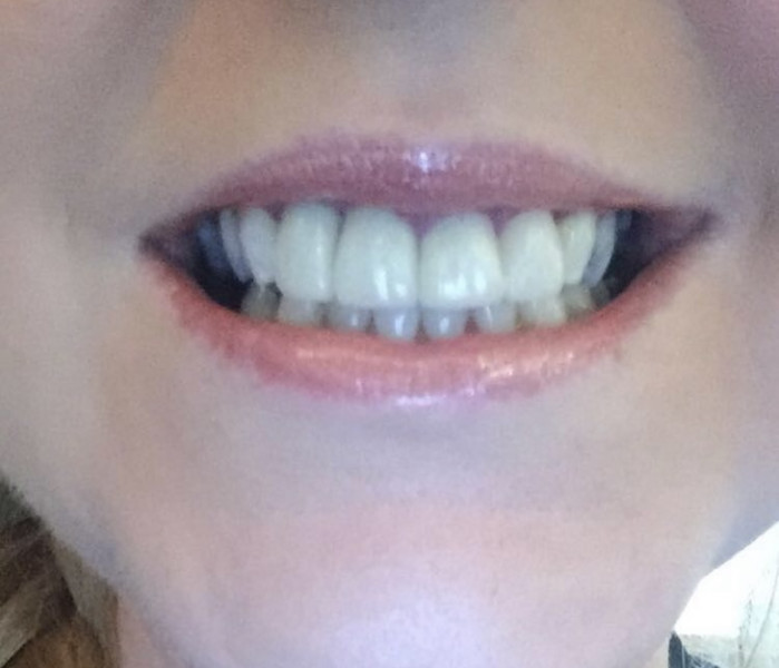 Cosmetic Dentistry £8k. Should I get a 2nd opinion? 