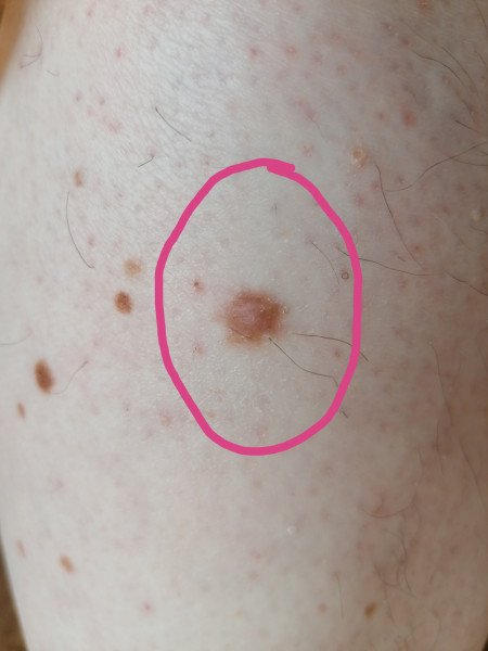 Is this mole something to worry about