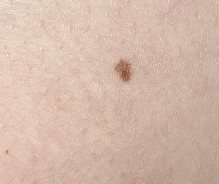 Does this mole look concerning? (Photos)