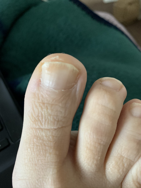 To try a toxic substance to cure my fungal toenail infections?