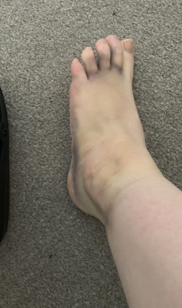 Ankle ligament recovery, normal or not? 