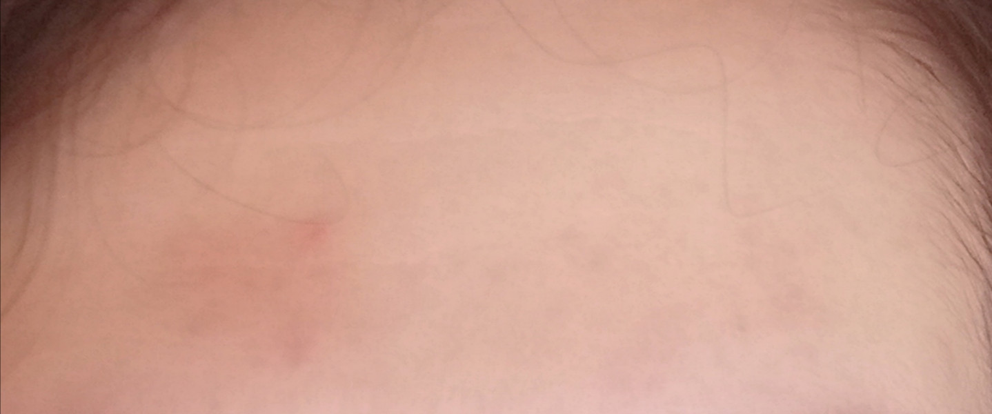 Discoloured forehead due to skin wearing away