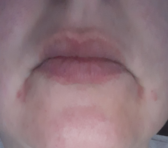 Spots around mouth, not Coldsores? 
