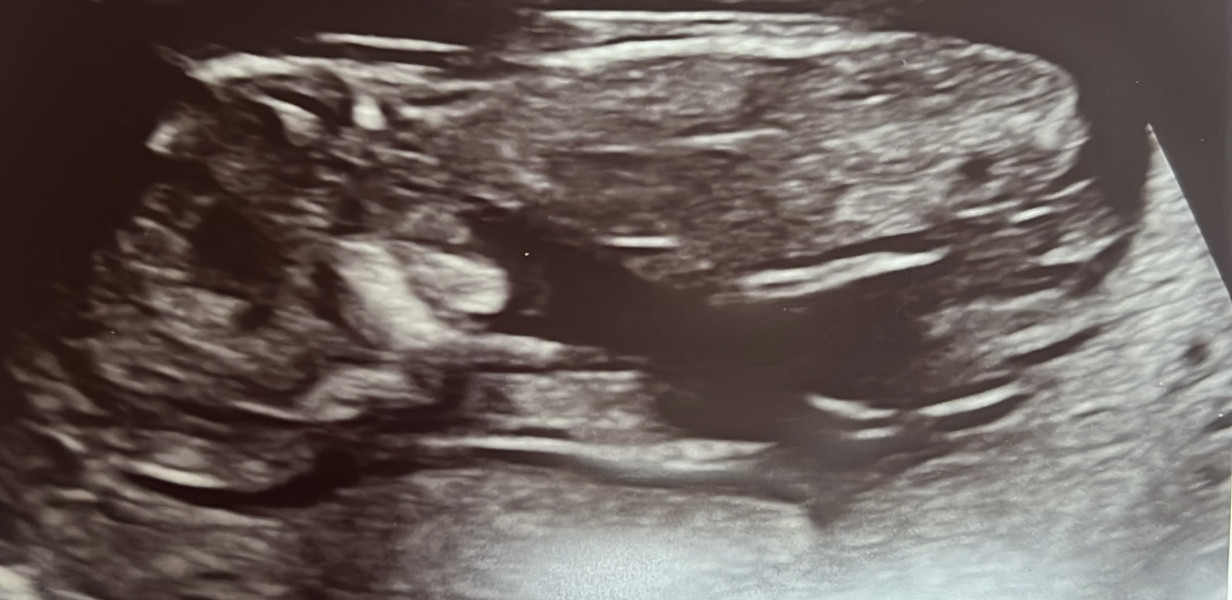 Navigating pregnancy after loss thread 2